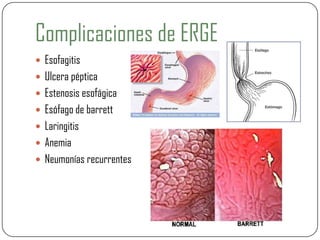 Complicaciones de ERGE
 Esofagitis
 Ulcera péptica
 Estenosis esofágica
 Esófago de barrett
 Laringitis
 Anemia
 Neumonías recurrentes
 
