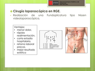  Cirugía laparoscópica en RGE.
• Realización de una Fundoplicatura tipo Nissen
videolaparoscópica,
Enfermería Quirúrgica Pediátrica y del
Adolescente
Sede Talca 2016
Ventajas:
• menor dolor,
• rápida
realimentación,
• corta estadía
hospitalaria,
• retorno laboral
precoz,
• mejor resultado
estético
 