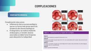 COMPLICACIONES
ESOFAGITIS EROSIVA
Complicación más común
● Inflamación de la mucosa esofágica
que en su forma más grave asocia la
existencia de úlceras esofágicas
● El diagnóstico se realiza mediante
endoscopia y si existen úlceras
asociadas se debe tomar biopsias
para descartar la malignidad
 
