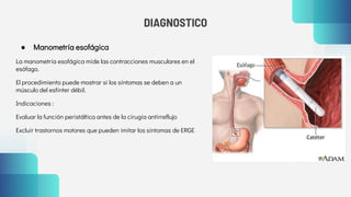DIAGNOSTICO
● Manometría esofágica
La manometría esofágica mide las contracciones musculares en el
esófago.
El procedimiento puede mostrar si los síntomas se deben a un
músculo del esfínter débil.
Indicaciones :
Evaluar la función peristáltica antes de la cirugía antirreflujo
Excluir trastornos motores que pueden imitar los síntomas de ERGE
 