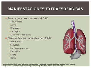  Asociadas a los efectos del RGE
 Tos crónica
 Asma
 Ronquera
 Laringitis
 Erosiones dentales
 Observados en pacientes con ERGE
 Neumonitis
 Sinusitis
 Laringoespasmo
 Faringitis
 SAOS
 Otitis
MANIFESTACIONES EXTRAESOFÁGICAS
Montoro, Miguel A.; García Pagán, Juan Carlos. Gastroenterología y Hepatología. Problemas comunes en la práctica clínica. 2ª Edición
Longo D., Fauci A., et al. Harrison’s Gastroenterology and Hepatology. 2nd edition.; McGraw-Hill Education 2013.
 