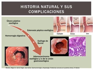 Úlcera péptica
esofágica
Estenosis péptica esofágica
Hemorragia digestiva
Esófago de
Barret
Adenocarcinoma
esofágico y/o de la unión
gastroesofágica
HISTORIA NATURAL Y SUS
COMPLICACIONES
Montoro, Miguel A.; García Pagán, Juan Carlos. Gastroenterología y Hepatología. Problemas comunes en la práctica clínica. 2ª Edición
 