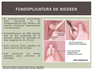  El procedimiento antirreflujo
más frecuente es la
fundoplicatura tipo Nissen. Se
realiza mediante laparotomía
o toracotomía.
 Fundoplicatura de 360 grados
que se fija alrededor de la
porción distal del esófago en
una longitud de 4 a 5 cm.
 Esta técnica hace posible un
buen control del reflujo.
 Uso exclusivo de fondo
gástrico para envolver el
esófago.
FUNDOPLICATURA DE NIESSEN
Manual CTO de Medicina y Cirugía. 8va edición. Digestivo y cirugía general.
Brunicardi et al. Schwartz. Principios de Cirugía. 9na edición. McGraw Hill
 