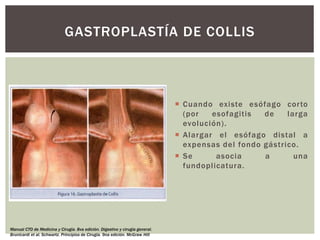  Cuando existe esófago corto
(por esofagitis de larga
evolución).
 Alargar el esófago distal a
expensas del fondo gástrico.
 Se asocia a una
fundoplicatura.
GASTROPLASTÍA DE COLLIS
Manual CTO de Medicina y Cirugía. 8va edición. Digestivo y cirugía general.
Brunicardi et al. Schwartz. Principios de Cirugía. 9na edición. McGraw Hill
 