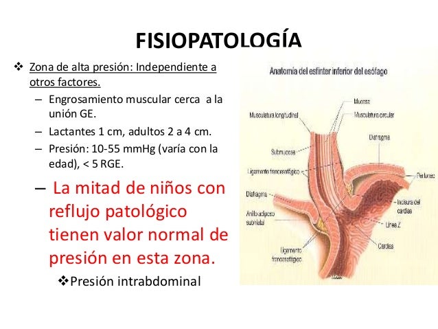 REFLUJO GASTROESOFAGICO EN NIÑOS REFLUJO GASTROESOFAGICO EN NIÑOS