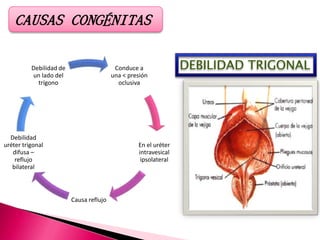 CAUSAS CONGÉNITAS
Conduce a
una < presión
oclusiva
En el uréter
intravesical
ipsolateral
Causa reflujo
Debilidad
uréter trigonal
difusa –
reflujo
bilateral
Debilidad de
un lado del
trígono
DEBILIDAD TRIGONAL
 