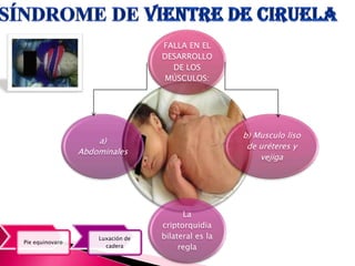 ,
FALLA EN EL
DESARROLLO
DE LOS
MÚSCULOS:
b) Musculo liso
de uréteres y
vejiga
La
criptorquidia
bilateral es la
regla
a)
Abdominales
Pie equinovaro
Luxación de
cadera
 