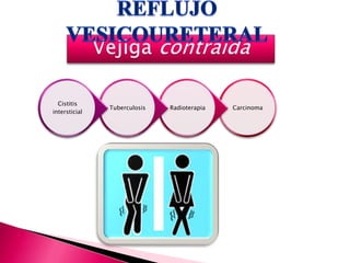 CarcinomaRadioterapiaTuberculosis
Cistitis
intersticial
 