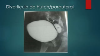 Divertículo de Hutch/parauteral
 