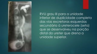 RVU grau III para a unidade
inferior de duplicidade completa
das vias excretoras esquerdas
secundária à ureterocele (seta)
que se desenvolveu na porção
distal do ureter que drena a
unidade superior.
 