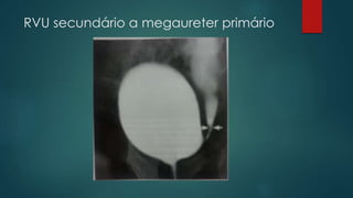 RVU secundário a megaureter primário
 