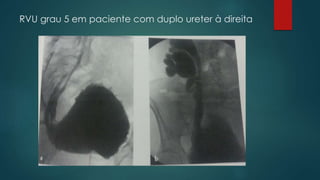 RVU grau 5 em paciente com duplo ureter à direita
 
