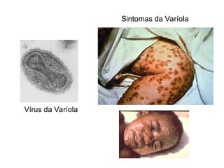 Vírus da Varíola
Sintomas da Varíola
 