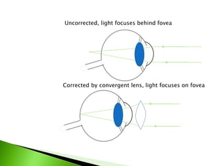 Uncorrected, light focuses behind fovea
Corrected by convergent lens, light focuses on fovea
 