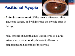 GRADING OF MYOPIA
• Low myopia(<-3D)
• Moderate myopia(-3D to -6D)
• High myopia(>-6D)
17
 