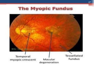 Fundus examination
• DEGENERATIVE CHANGES
IN RETINA AND CHOROID
-common in progressive myopia
-chorioretinal atrophic patc...