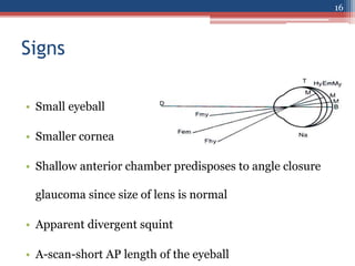 Signs
• Small eyeball
• Smaller cornea
• Shallow anterior chamber predisposes to angle closure
glaucoma since size of lens is normal
• Apparent divergent squint
• A-scan-short AP length of the eyeball
16
 