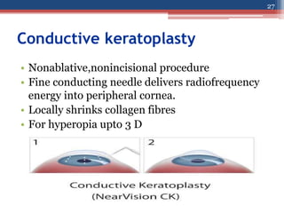 Conductive keratoplasty
• Nonablative,nonincisional procedure
• Fine conducting needle delivers radiofrequency
energy into peripheral cornea.
• Locally shrinks collagen fibres
• For hyperopia upto 3 D
27
 