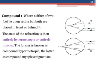 Compound : Where neither of two
foci lie upon retina but both are
placed in front or behind it.
The state of the refraction is then
entirely hypermetropic or entirely
myopic. The former is known as
compound hypermetropic, the latter
as compound myopic astigmatism.
38
 