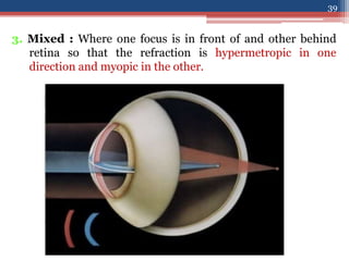 3. Mixed : Where one focus is in front of and other behind
retina so that the refraction is hypermetropic in one
direction and myopic in the other.
39
 