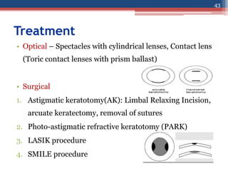 Treatment
43
• Optical – Spectacles with cylindrical lenses, Contact lens
(Toric contact lenses with prism ballast)
• Surgical
1. Astigmatic keratotomy(AK): Limbal Relaxing Incision,
arcuate keratectomy, removal of sutures
2. Photo-astigmatic refractive keratotomy (PARK)
3. LASIK procedure
4. SMILE procedure
 