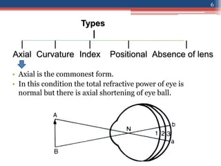 Types
|
| | | | |
Axial Curvature Index Positional Absence of lens
• Axial is the commonest form.
• In this condition the total refractive power of eye is
normal but there is axial shortening of eye ball.
6
 