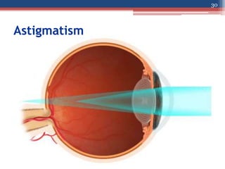 Regular Astigmatism
• Light rays passing through a steep meridian are
deflected more than those passing through a
flatter ...