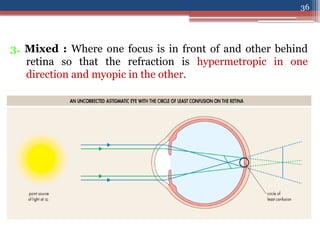 Error Refraction Refraction-II, types of refractive errors | PPTX