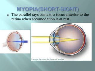  The parallel rays come to a focus anterior to the
retina when accomodation is at rest.
 