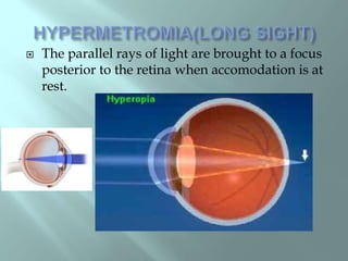  The parallel rays of light are brought to a focus
posterior to the retina when accomodation is at
rest.
 