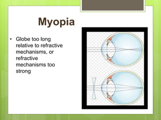 Myopia
• Globe too long
relative to refractive
mechanisms, or
refractive
mechanisms too
strong
 