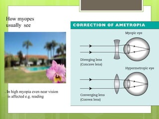 How myopes
usually see
. In high myopia even near vision
is affected e.g. reading
 