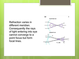 Refraction varies in
different meridian.
Consequently the rays
of light entering into eye
cannot converge to a
point focus but form
focal lines.
 