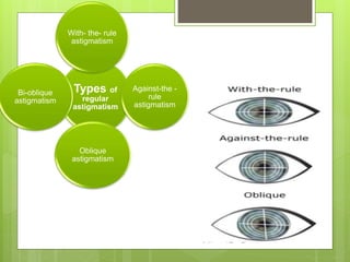 Types of
regular
astigmatism
With- the- rule
astigmatism
Against-the -
rule
astigmatism
Oblique
astigmatism
Bi-oblique
astigmatism
 