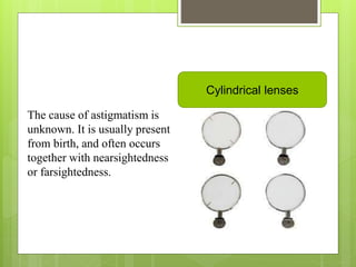 The cause of astigmatism is
unknown. It is usually present
from birth, and often occurs
together with nearsightedness
or farsightedness.
Cylindrical lenses
 