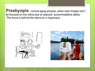 Presbyopia : normal aging process, when near images can’t
be focused on the retina due to reduced accommodative ability.
The focus is behind the retina as in hyperopia.
 