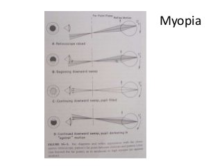 Myopia
 