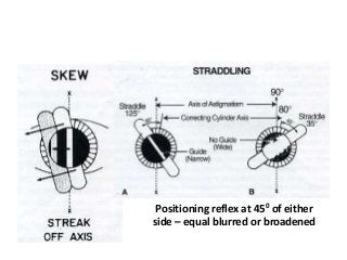 Positioning reflex at 450 of either
side – equal blurred or broadened
 