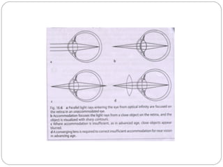 Refractive error | PPT