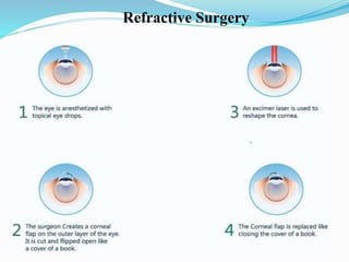 Refractive Surgery
 