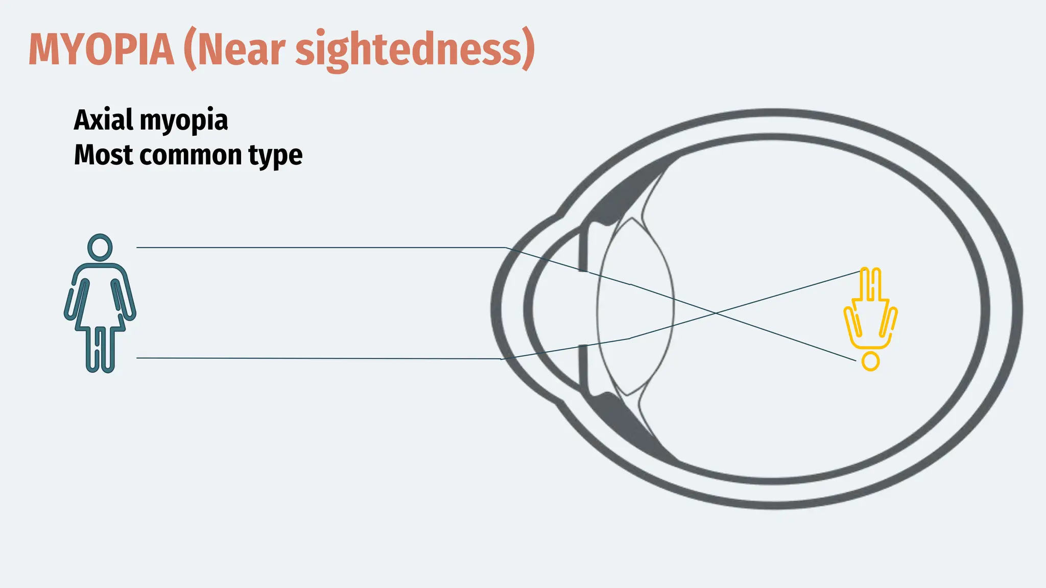 MYOPIA (Near sightedness)
Axial myopia
Most common type
 