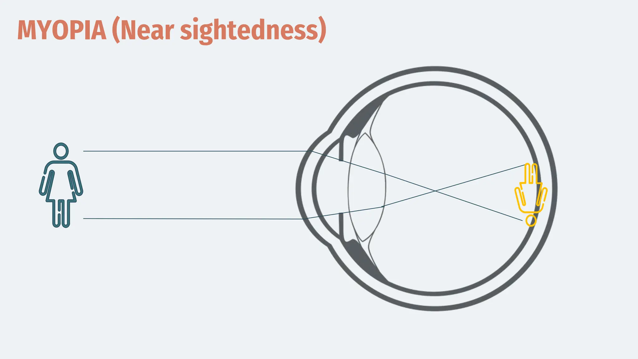 MYOPIA (Near sightedness)
 