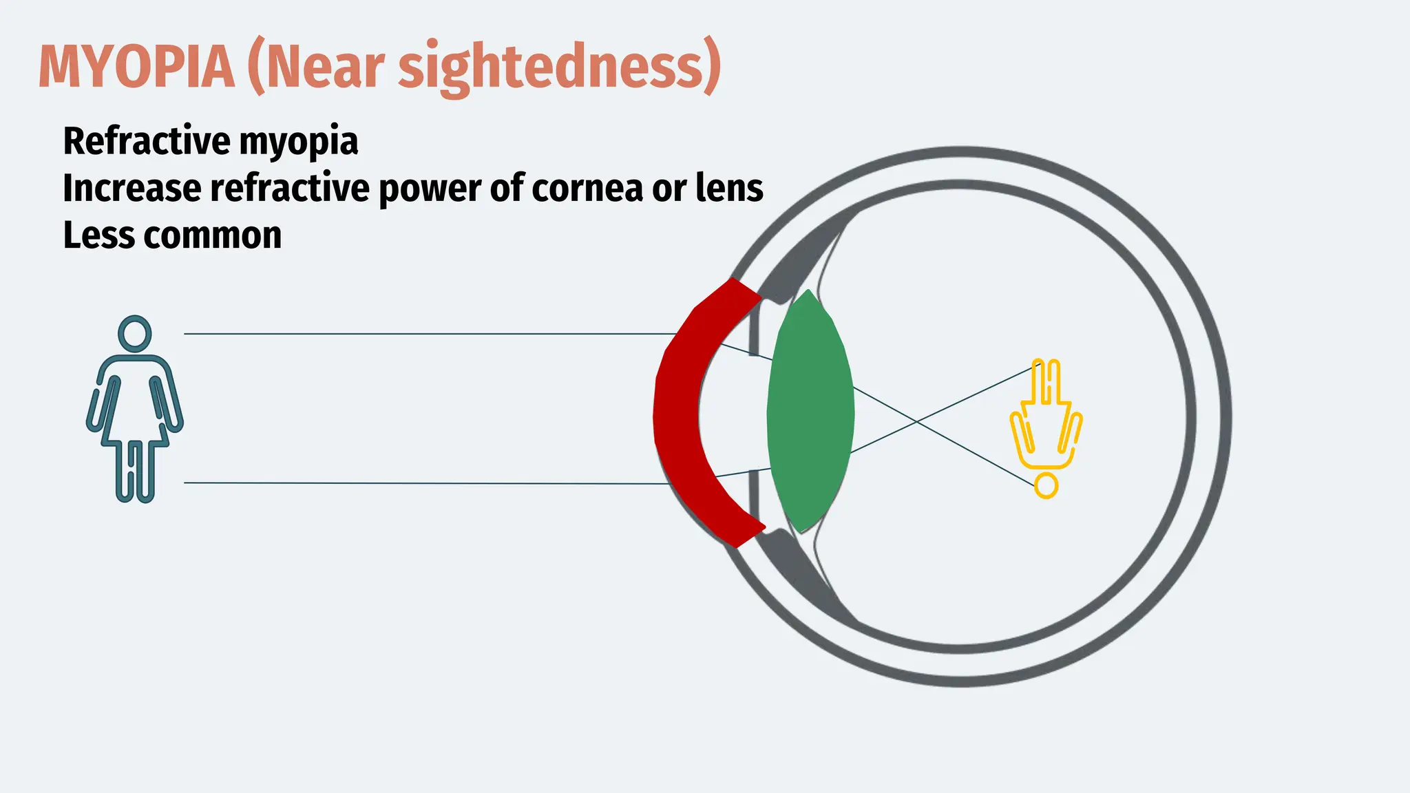 MYOPIA (Near sightedness)
Refractive myopia
Increase refractive power of cornea or lens
Less common
 