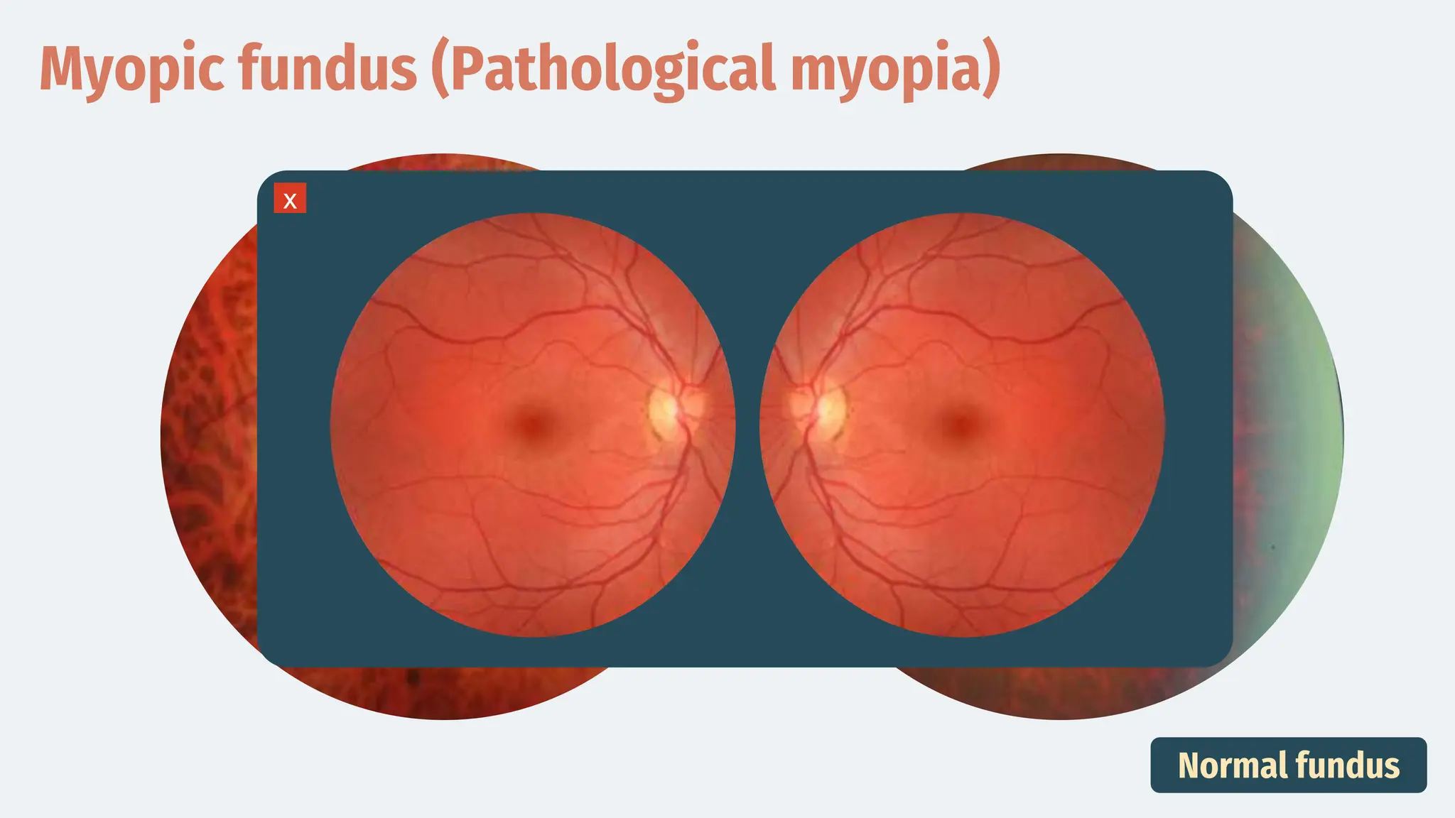Myopic fundus (Pathological myopia)
Normal fundus
x
 