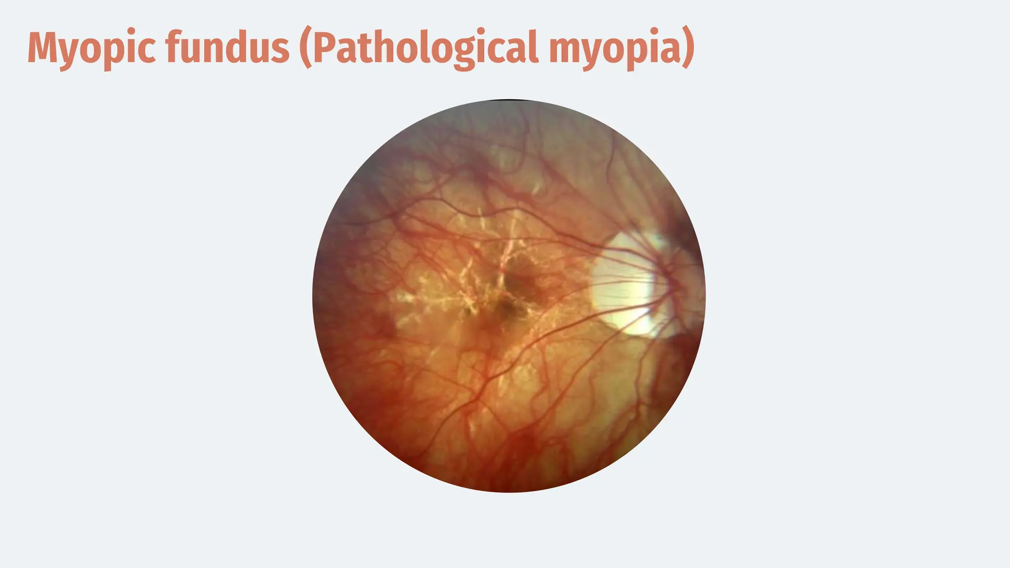 Myopic fundus (Pathological myopia)
 