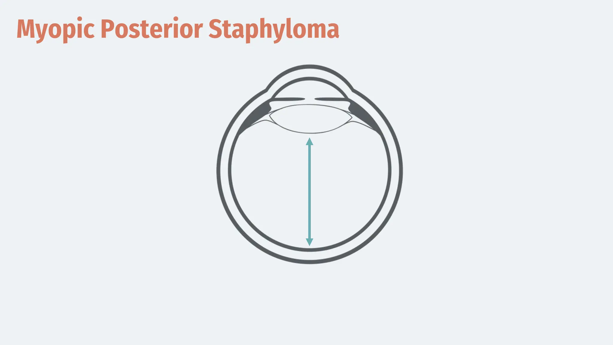 Myopic Posterior Staphyloma
 