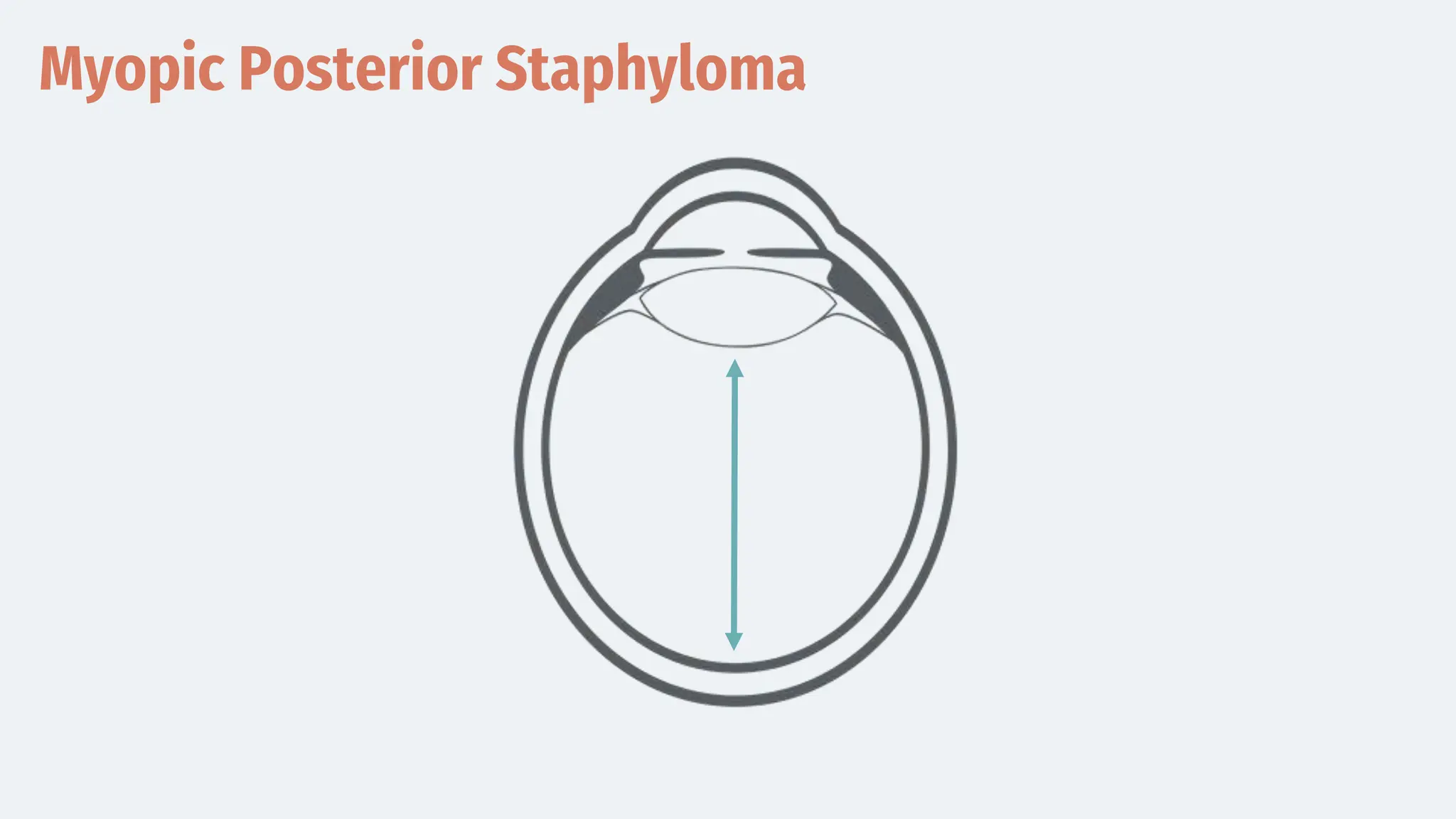Myopic Posterior Staphyloma
 