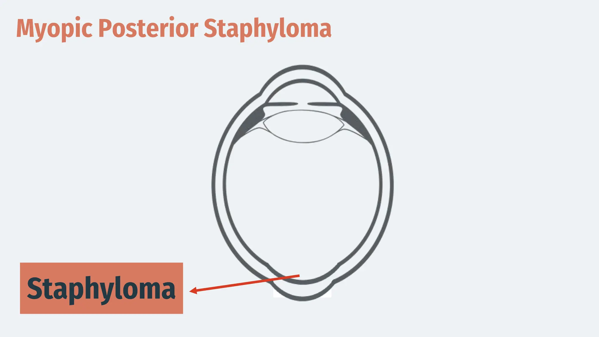 Myopic Posterior Staphyloma
Staphyloma
 