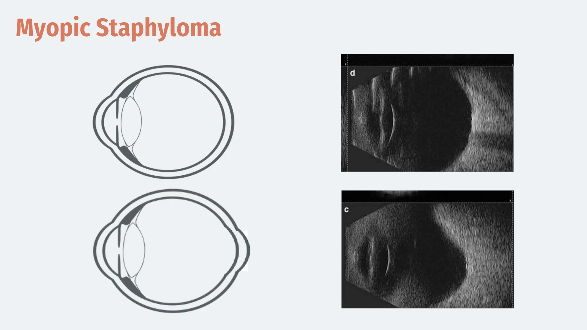 Myopic Staphyloma
 