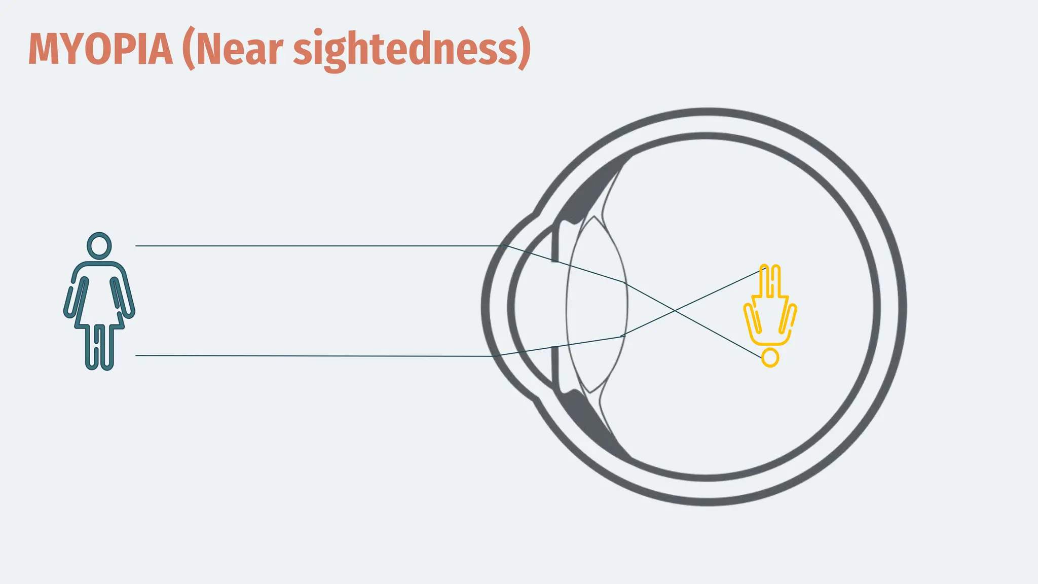 MYOPIA (Near sightedness)
 